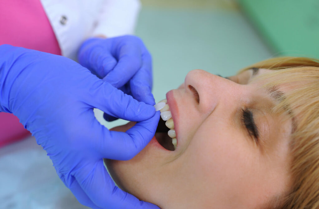 Close-up hands of a dentist installing dental veneers on the teeth of a female patient