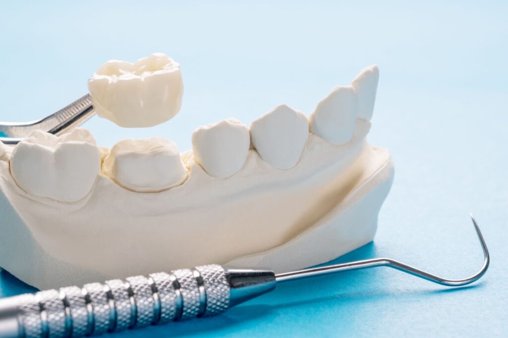 A close-up of a crown over a model of teeth on a table.