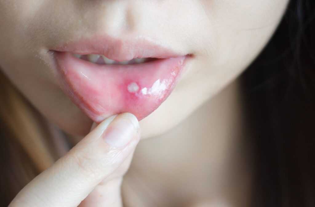 Person pulling down their bottom lip to show a canker sore inside the mouth.
