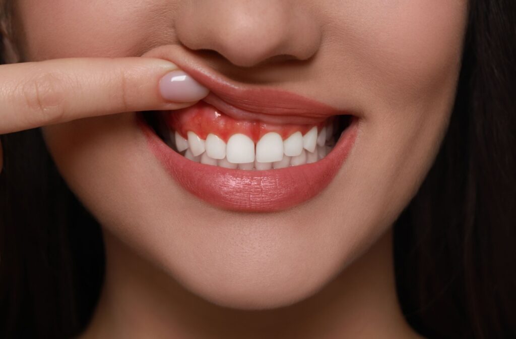 A close up of a persons mouth with white clean teeth but red irritated gums
